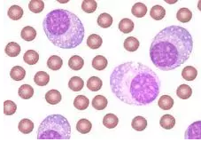 某研究所发明治疗多发性骨髓瘤的治疗新靶点