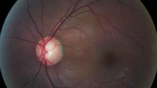 青光眼的克星来袭，，，，，，助力患者远离视力的“窃贼”