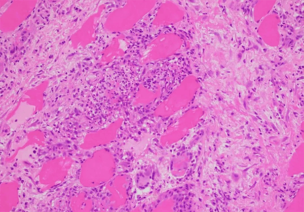 【GA黄金甲助力】治疗结节病的KBMAB-16获FDA批准临床